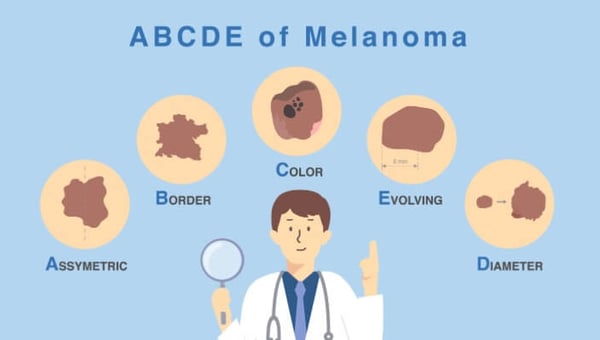 ABCDE-Melanoma