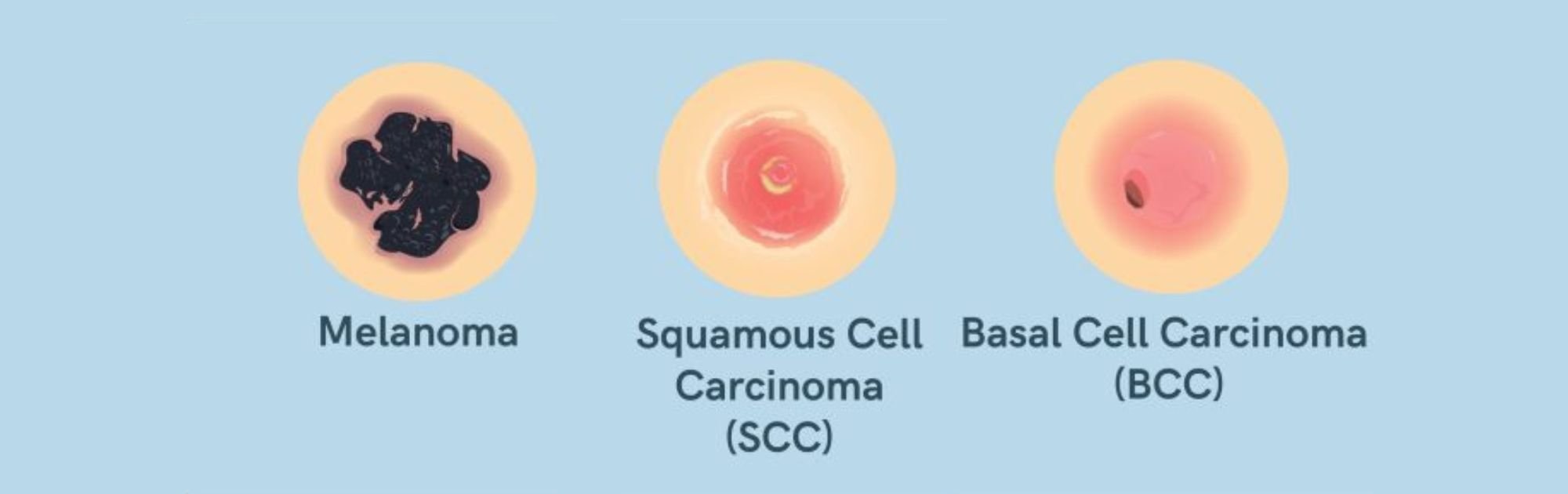 types of skin cancer